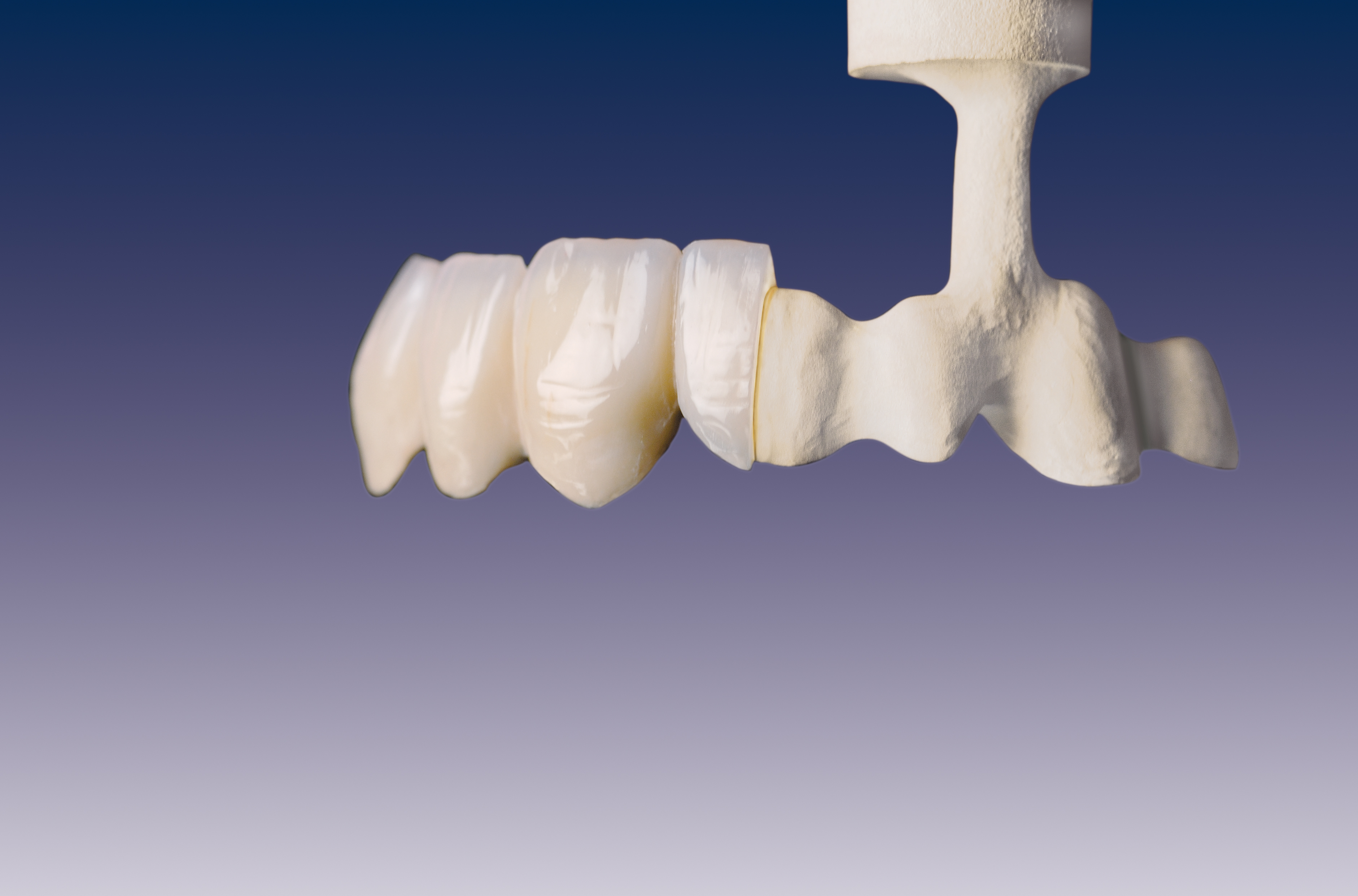 dental metal substructure