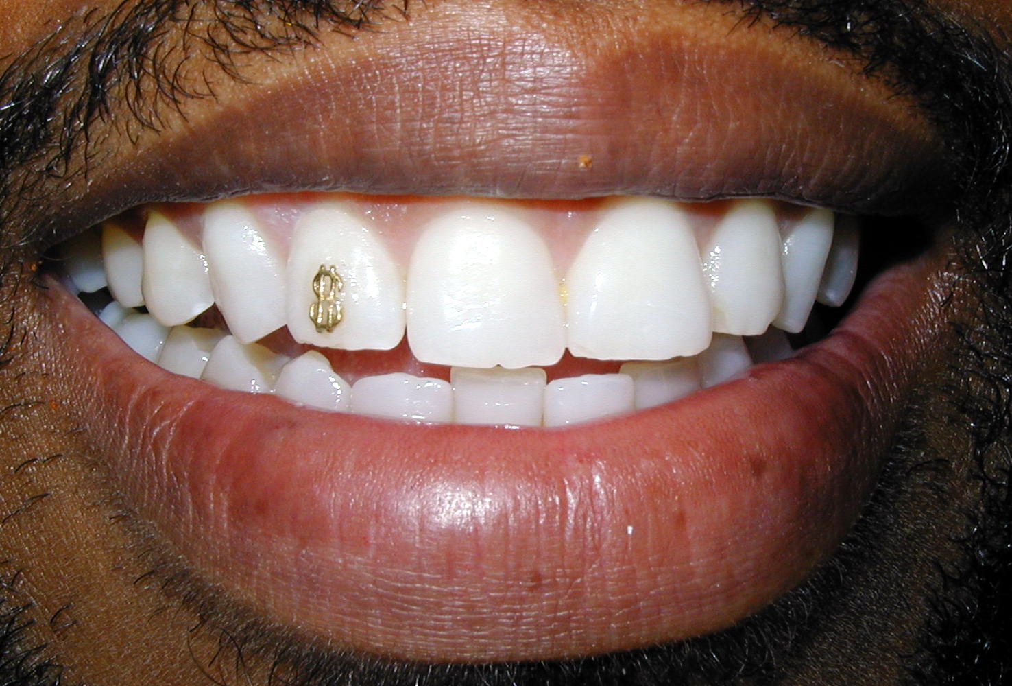 Teeth Jewels are Better than Teeth Grills