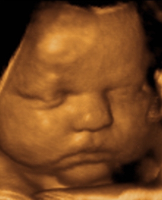 Prenatal 3D Ultrasound Image
