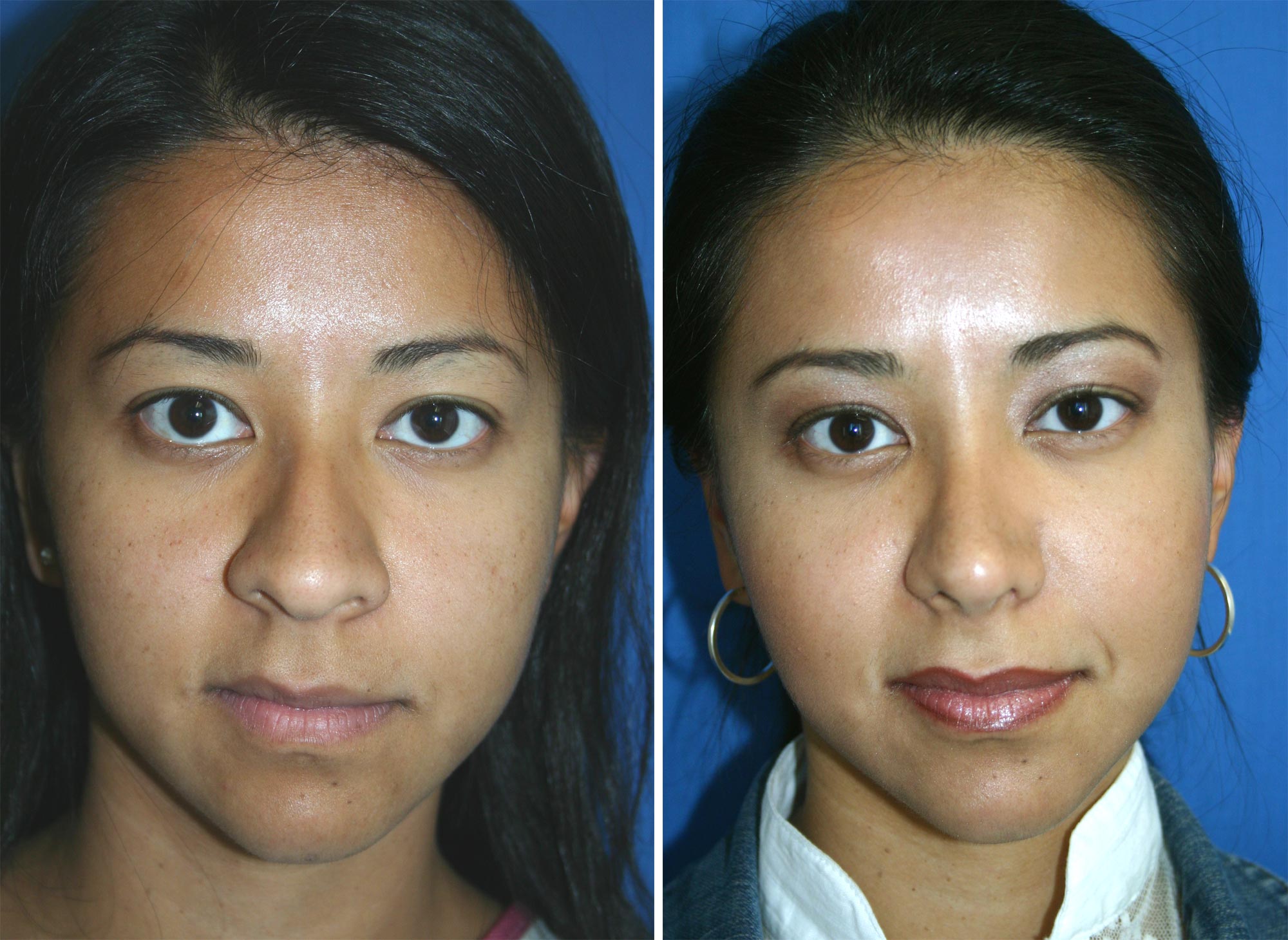 Rhinoplasty2.jpg