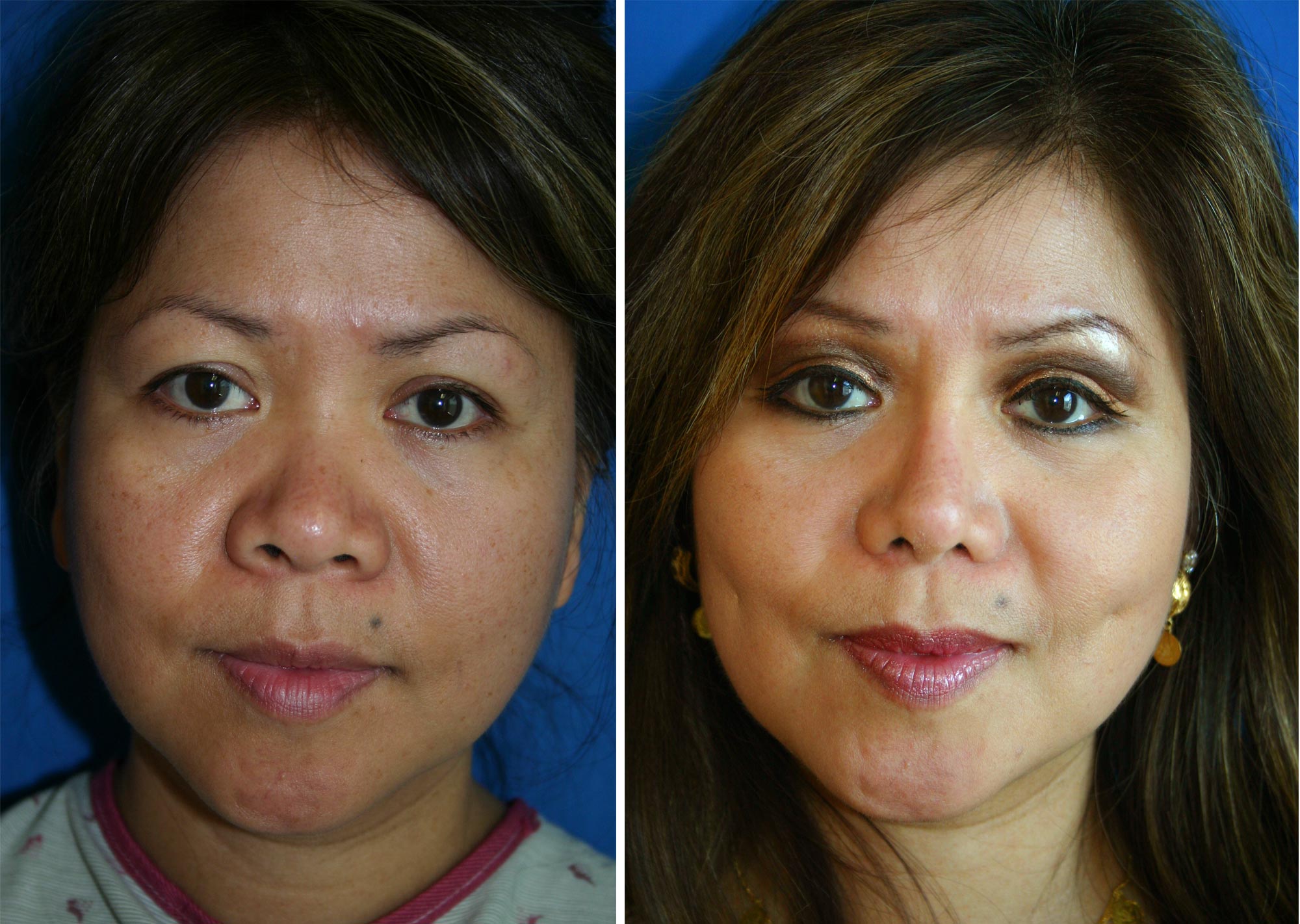 Facial flap surgery