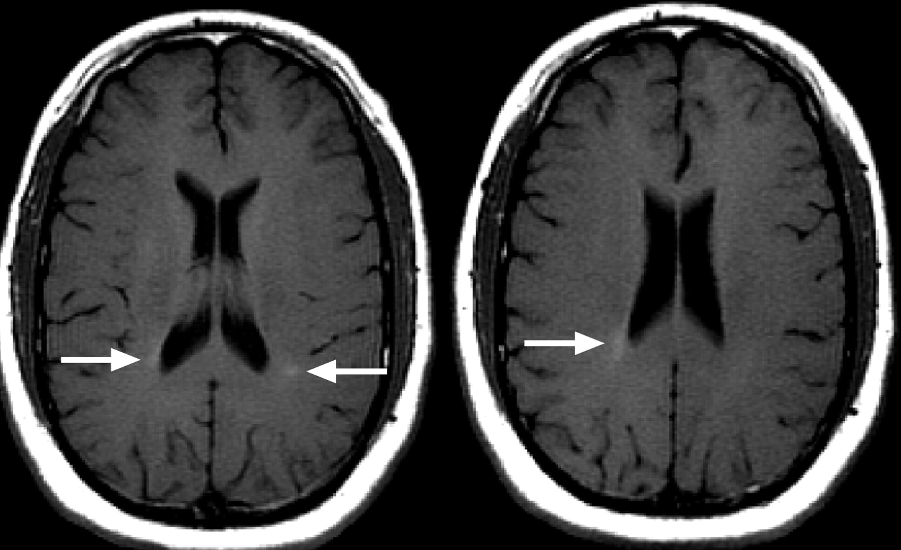 What Do Lesions Look Like On A Brain Mri