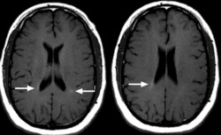 lesions ms multiple sclerosis mri t1 findings light disease hyperintense weighted old finding problems patients progression mr remitting relapsing gadolinium