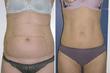 Beverly Hills Aesthetics: EZ LIPO(TM) ''A Gentle Way to Zap...