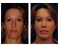 Face Fat Transfer