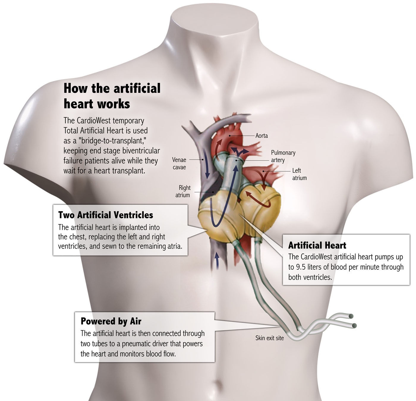 CardioWest™ Artificial Heart Approved For Highest ...