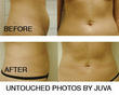 Smartlipo Pioneers, Doctors Katz and Bruck of Juva, to Present...