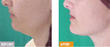 Dr. Vulich to Speak About a Revolutionary Alternative to Liposuction...