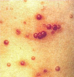 how to treat ringworm on skin