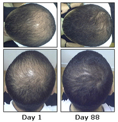 Hair Loss Treatment