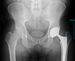Oh Law Firm >> Hip Replacement Patients at Possible Risk, Cleveland Law Firm Adds Zimmer Durom® Cup Lawsuit ... Oh Law Firm >> Hip Replacement Patients at Possible Risk, Cleveland Law Firm Adds Zimmer Durom® Cup Lawsuit ...