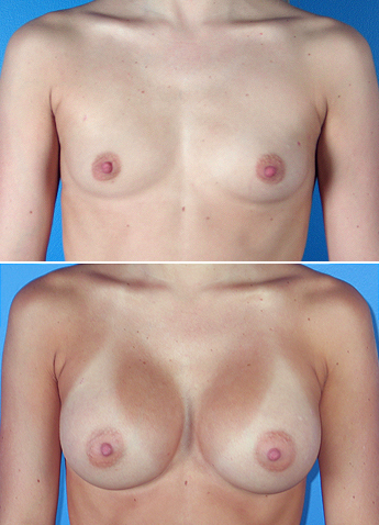 breast augmentation photos. Breast Augmentation Atlanta GA