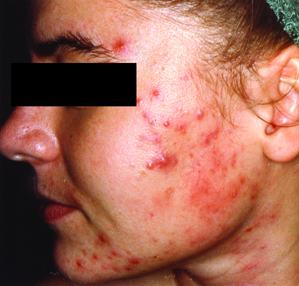 Acne Scars Treatment Worth it? Reviews, Cost, Pictures ...