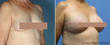 a study on breast reconstruction after mastectomy a study on breast reconstruction after mastectomy