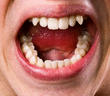 Squeamish Colorado Dental Patients Get Drilled By Self-Interested...