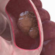 Inoperable Colon Cancer Responds to New Treatment
