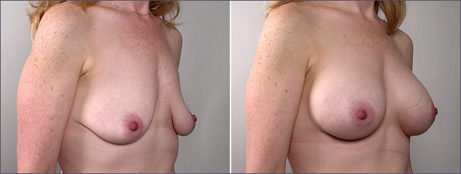 breast augmentation pictures. Breast Augmentation New Jersey