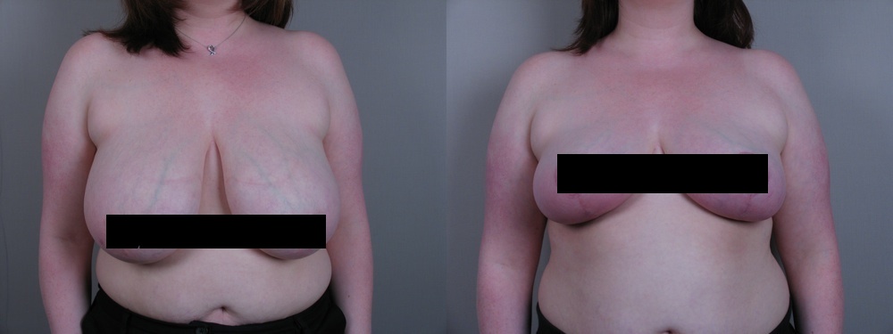 breast reduction cost. reast reduction before and