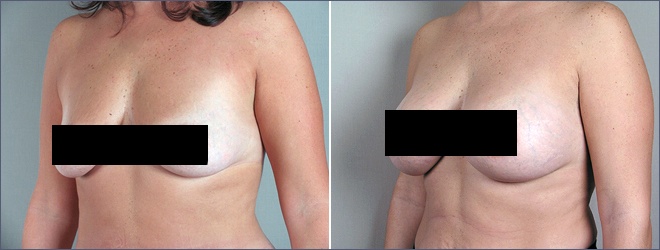 breast implants before and after. New Jersey Breast Augmentation