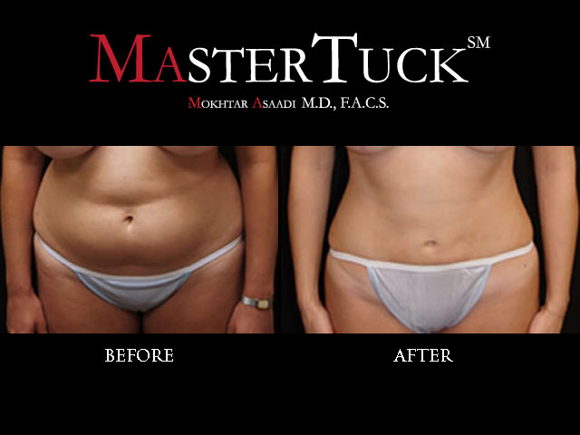 tummy tuck scars. or tummy tuck, but without