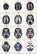 Syntermed Launches NeuroQ 3.5 - Nuclear Medicine Diagnostic Program at Alzheimer’s Association 2010 International Conference 