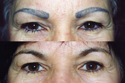 Before and after photos of eyebrow tattoo removal.