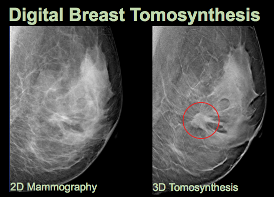 Digital tomosynthesis breast