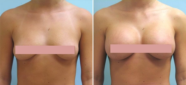 vinings breast ga surgery implant