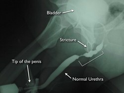 New Urethral Stricture Disease Treatment Options Offer A Curative