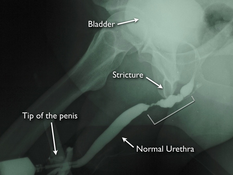 New Urethral Stricture Disease Treatment Options Offer A Curati