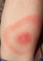 A photograph of a Lyme disease tick bite circular rash can help in proper lyme testing and diagnosis