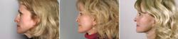 New Jersey Facelift Patient