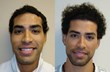 Hair Transplant Pioneer Launches the MAXHARVEST™ Plus