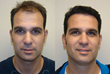 Dr. Brett Bolton Announces MAXHARVEST™ Live Surgery Workshop