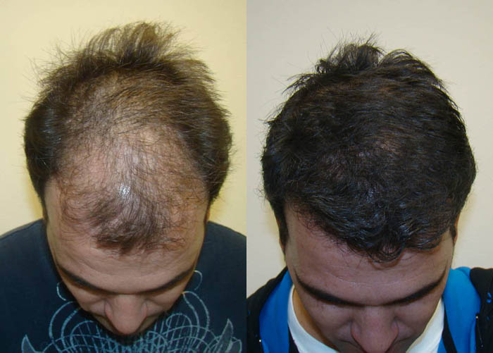 Great Hair Transplants Now Featured On Hair Transplant Society Review  Website