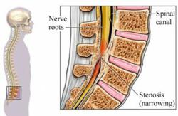 Spinal Stenosis Image