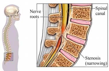 spine stenosis