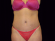After Tummy Tuck Surgery
Without Waist Enhancement
