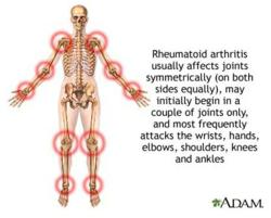 Rheumatoid Arthritis usually affects joints symmetrically, may initially begin in a couple of joints only, and most frequently attacks the wrists, hands, elbows, shoulders, knees and ankles