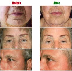 Before and After Facial Photos