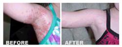 ZymaDerm before and after photos of mollusum contagiosum
