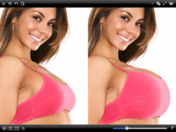 Breast augmentation simulated with the Plastic Surgery Simulator.