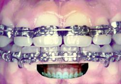 banded braces