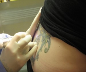 Tattoo Removal using the Q Switched Laser Laser Tattoo Remvoal