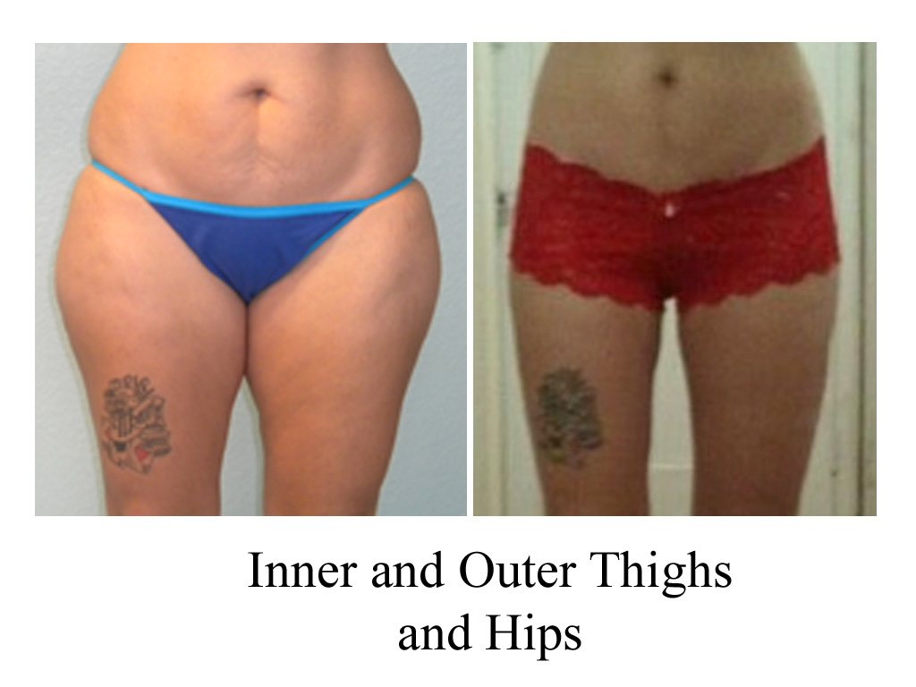 liposuction hips and thighs cost