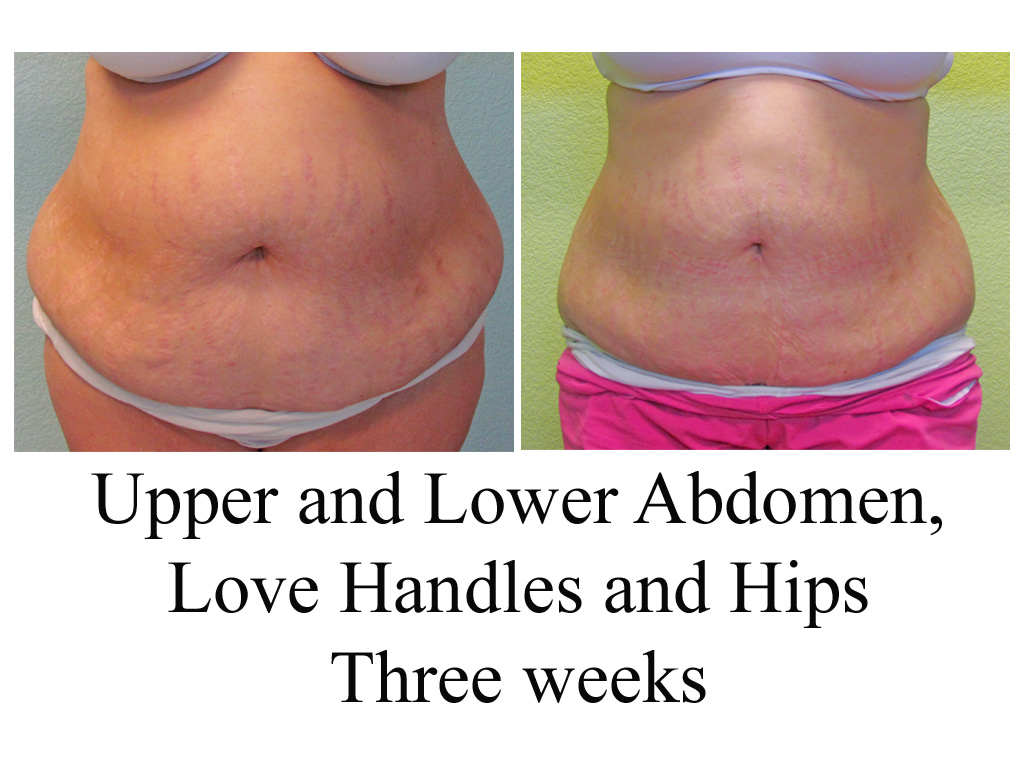 lipo without tummy tuck cost