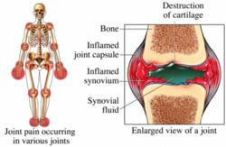 Rheumatoid Arthrits