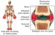Achieve Clinical Research Is Conducting New Rheumatoid Arthritis...