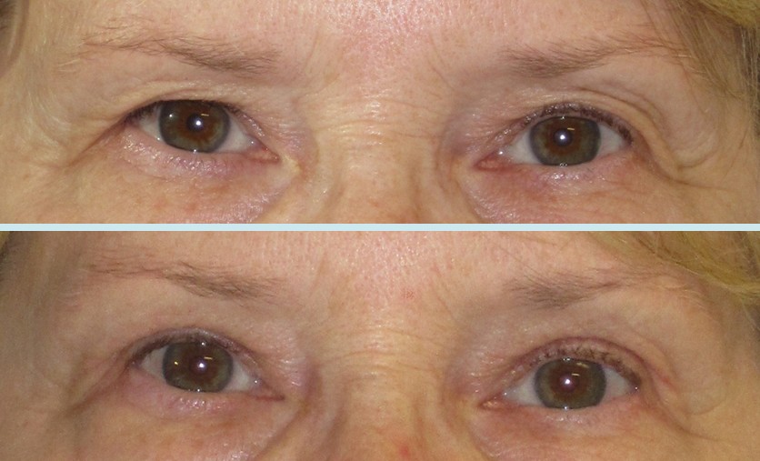 Eye Lift Pictures