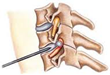 Putting an End to Spinal Facet-Joint Pain; Acclaimed Surgeon Dr....